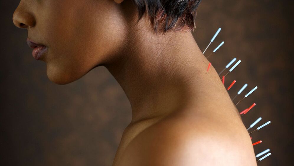 Acupuncture na may cervical osteochondrosis