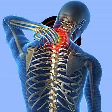 Ang sakit sa leeg na may cervical osteochondrosis