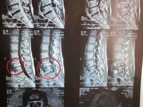 Diagnosis ng cervical osteochondrosis