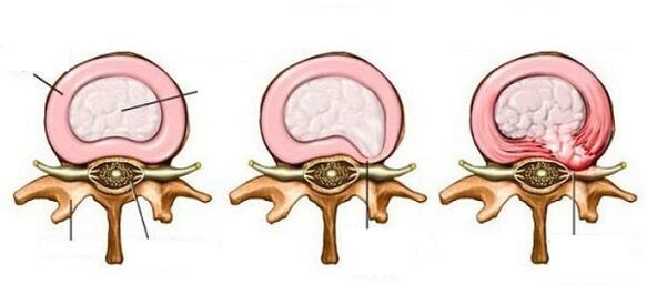 Intervertebral hernia na may cervical osteochondrosis
