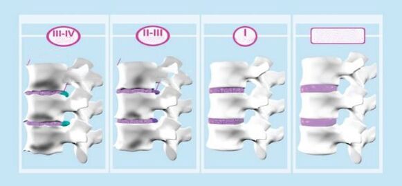 Mga yugto ng cervical osteochondrosis