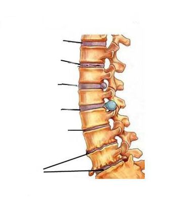 Paano bubuo ang osteochondrosis
