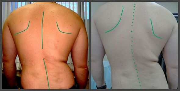 kurbada ng gulugod na may osteochondrosis