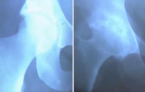 Scum ng arthrosis ng kasukasuan ng tuhod