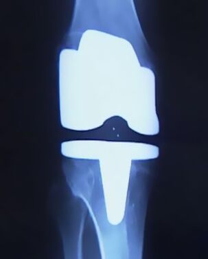 X -ray larawan ng tuhod na may isang artipisyal na prosthesis pagkatapos ng operasyon upang baguhin ang magkasanib
