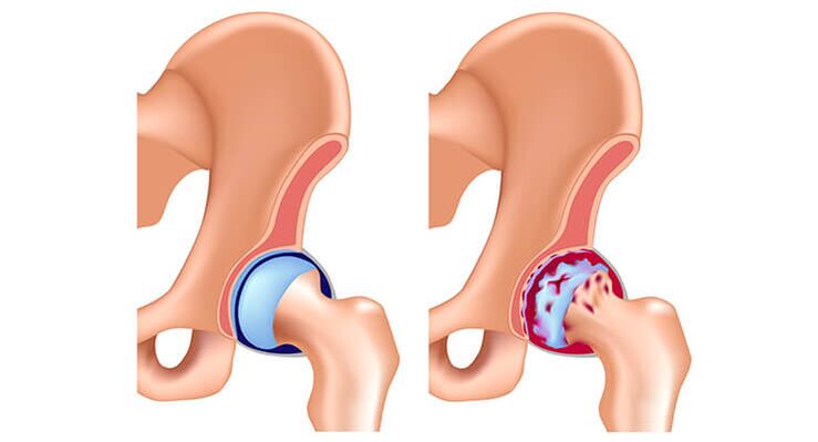 malusog at arthrosis-affected hip joint