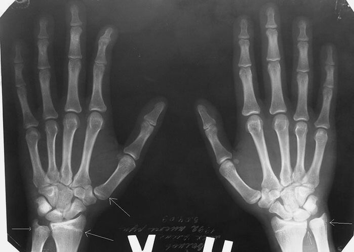 X-ray para sa sakit sa mga kasukasuan ng mga daliri