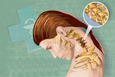 Mga sintomas ng reflex ng osteochondrosis
